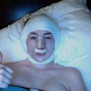 Hours after surgery...looking rough.