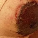 other nipple bleeding and peeling