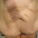 night before surgery - frontal 