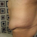night before surgery - side view 