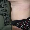 2 wks post op - side view 