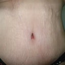 2 weeks post op - frontal 