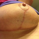 Right breast at 38 days post op.