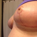 Left breast at 38 days post op.