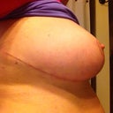 Left side incision, this side is still tender, unable to sleep on this side yet.  38 days post op
