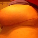 Right side incision, I can sleep on this side now.  38 days post op