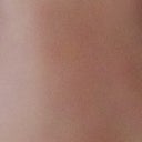 5.5 weeks post op - face at rest