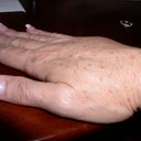 Radiesse Filler 8-29-12 12 days after procedure.
Huge knot on top of my hand