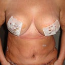 Day 3 Post Op- SWELLING sucks. I can imagine a flat tummy under there, but there's lots of swell hell going on.