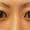 Before-1 month pre op.  Very heavy uneven upper lids with excessive fat and skin.  Right eye lid lays over eyelash line