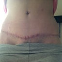 Tummy tuck scar 6months po