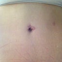 Belly button scar 6 month po