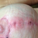 Boob after over applying Tretinoin and Hydroquinone.