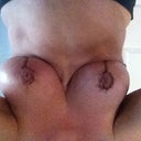 2 week post op..the scabby look is being held on by the glue..its just starting to fall off :-)