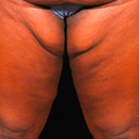 Thigh Lift