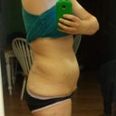 side, the kinda bad.. I had flank lipo done a few years back..they took the max out they could safely take(9lbs)... you can see i still have a bit of love handle so i hope he gets that during surg.