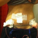 post op day 1, I am hunched over in this pic. I feel so skinny!!
