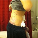 post op day 1, I am pretty swollen still, but no more dunlap yay!!