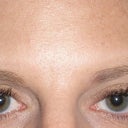 after eye surgery 2 mos, still a little puffiness in left eyelid