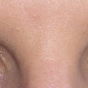 after eyelid surgery day 12
