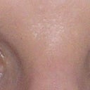 after eyelid surgery day 9