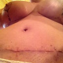 PO Week 3 Shows how the scabs are coming off.  Not pretty but gives people an idea on what 21 days look like.