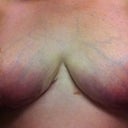 4 Weeks!!!   Incisions are pretty much completely healed except a bit around my nipples.   But i do see those spots closing up so it won't be long!