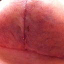 Left side underneath at 4 weeks.  Pretty much closed up.