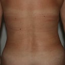6 weeks post op and right after taking off my garment, hence the marks on my skin