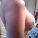 After explant and lift