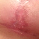 The bad spot all healed!'n yay