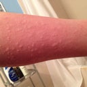 My leg broke out into hives from being overheated - if this occurs, make sure to not ignore the signs and use aloe Vera before it turns into real burns!