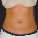 Anterior view pre-prodecure 5/30