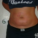 Anterior view a few hours post-procedure. Looks like I was punched in the belly multiple times