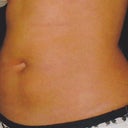 Right oblique pre-procedure 5/30
