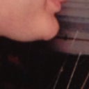 Before. Can be compared w previous pic. Gained weight here. Went to address double chin. Almost as an afterthought, I mentioned if something could be done about chubbiness of cheeks chin. Biggest mistake of my life. But the worst part has been his utter dismissal of me.