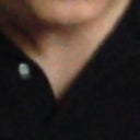 After. Flattened. Broadened. Stark unnatural gap and removal of volume has  caused disconnection of naso-labial fold. The result of this connection, that line has become a diagonal slash across my face rather protruding forward to me chin. This appeared to age me a decade only weeks post op. this and previous photo only 3.5 years apart. I am healthy.