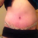 1 week after surgery. undies are down. its not a high scar.