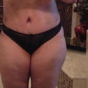 These are my lowest panties, barely covering the incision