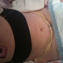 Day 1 Post Op
