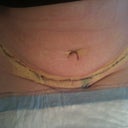 Day 1 Post Op