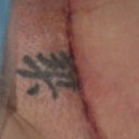 Close up of incision Day 3 Post Op - looks like I may of lost a little of the top of the tattoo. Just means I'll have to get it "fixed" - perhaps one around my incision - way down the road.