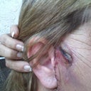 This was after the second surgery to repair a stitch the came loose. The Dr. Pulled my skin too tight and it peeled off the side of my face. No Problem, he says, I can fix it..