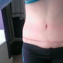 Eleven weeks post op, immediately after a step workout with binder