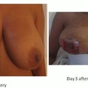 Breast 