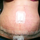 1 week post op