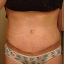 Looking pretty good! Still some swelling left in the lower abs and pelvic area