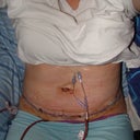 48 hours after surgery