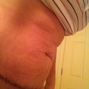 2 weeks post op-now that a little swelling has gone down, my skin is looking loose when I bend