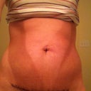 2 weeks post op--standing straight up